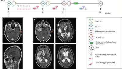 Hydrocephalus Shunting in Supratentorial Glioblastoma: Functional Outcomes and Management